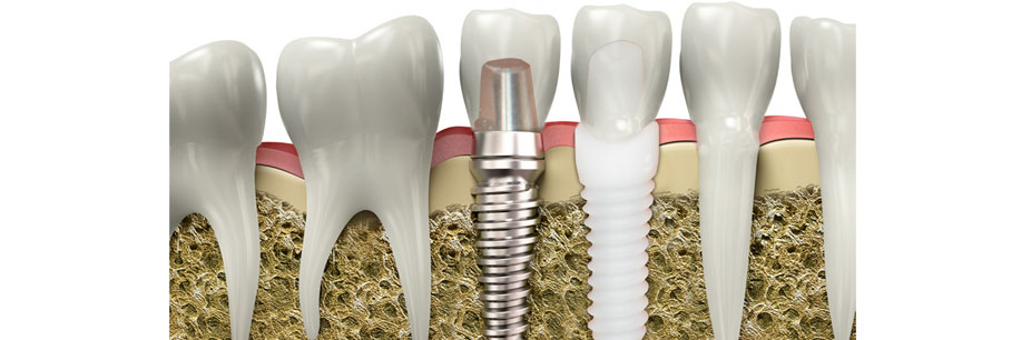 ZIRCONIUM IMPLANT